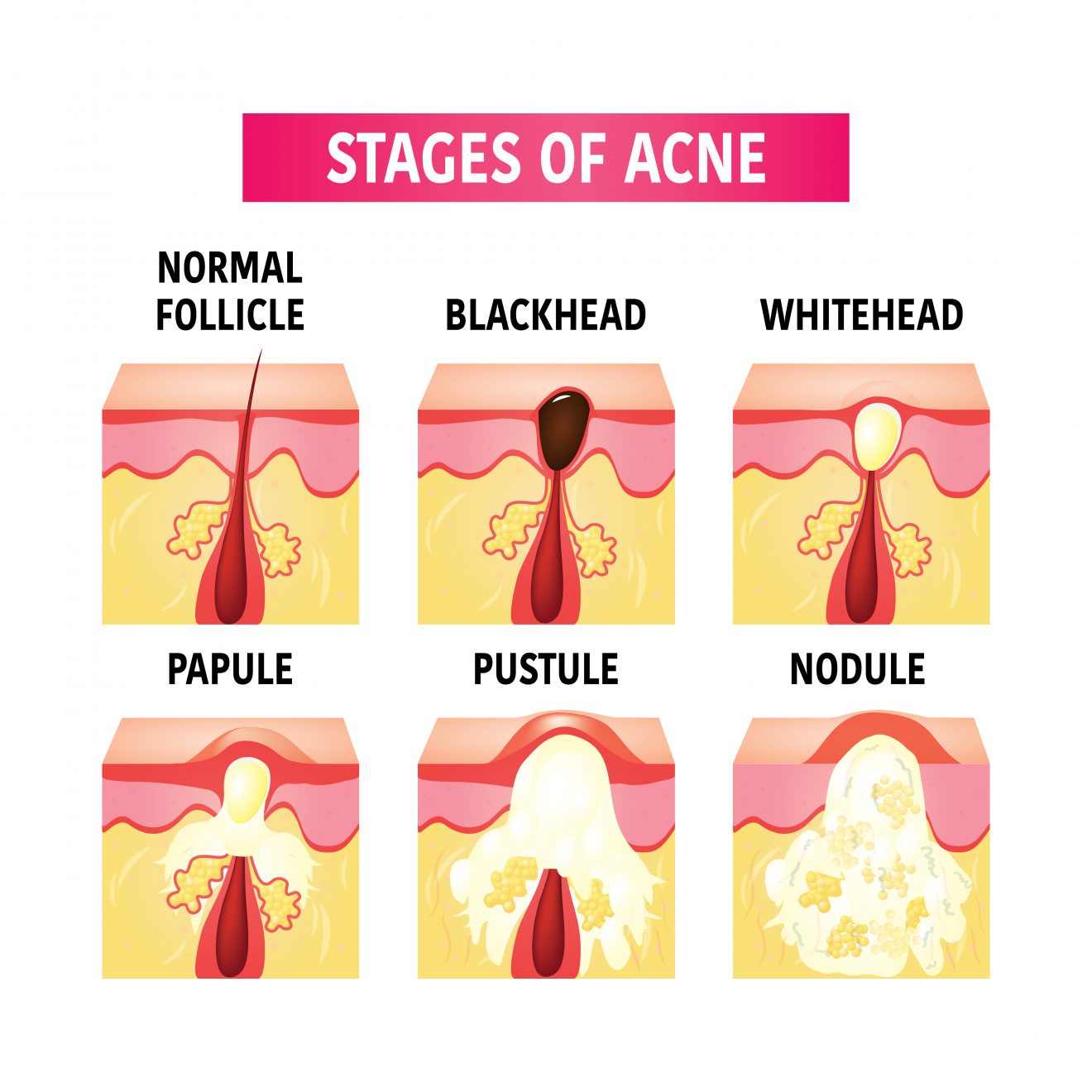 How to fight acne