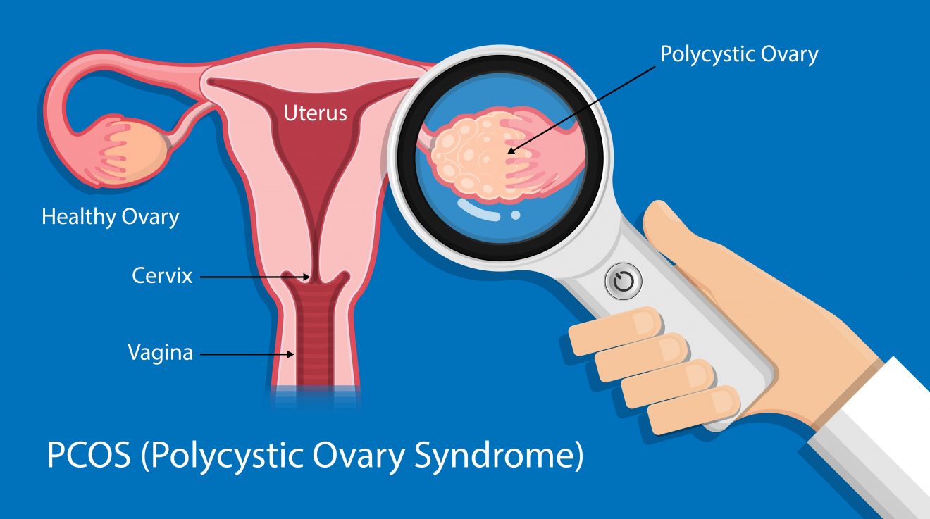 how-to-fight-pcos