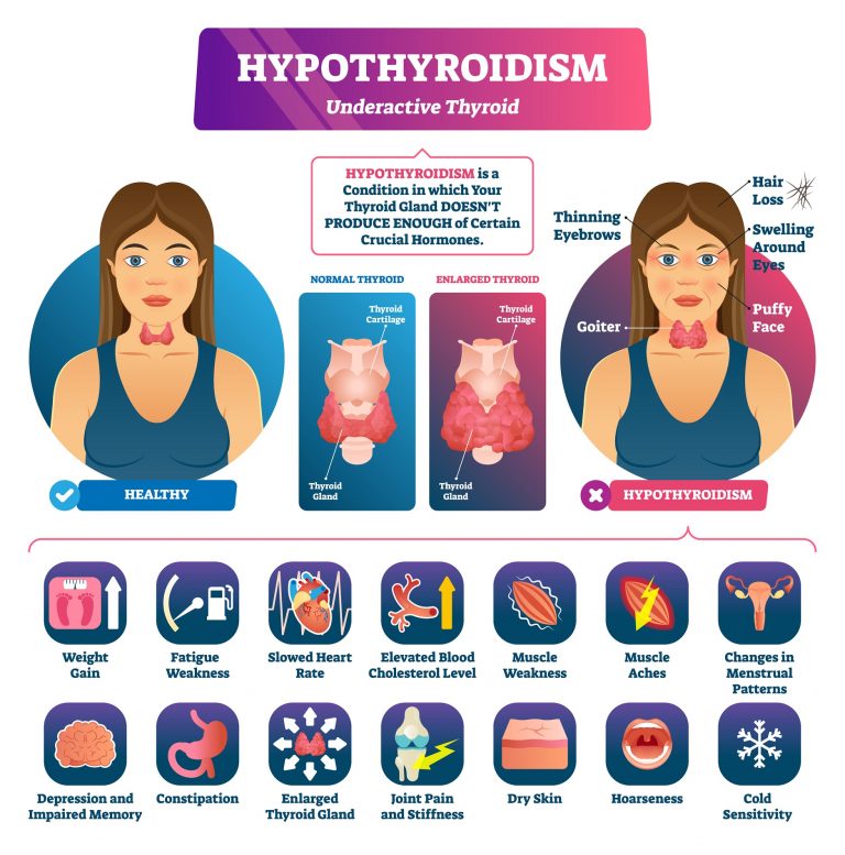 Can High Stress Cause Hypothyroidism