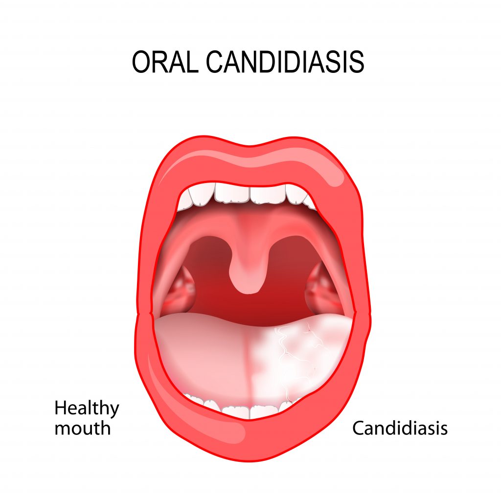 Candidosis symptoms